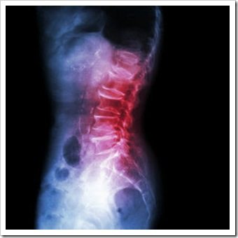 Back Pain Limerick PA Arthritis
