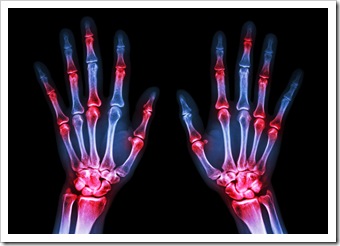 Rheumatoid Arthritis Solutions Limerick PA