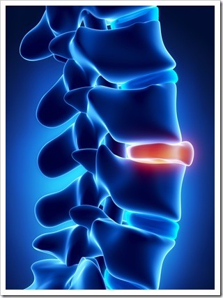 Slipped Disc Limerick PA